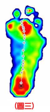 認識不同足患的足底壓力3