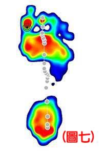 認識不同足患的足底壓力7