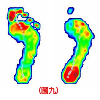 認識不同足患的足底壓力9